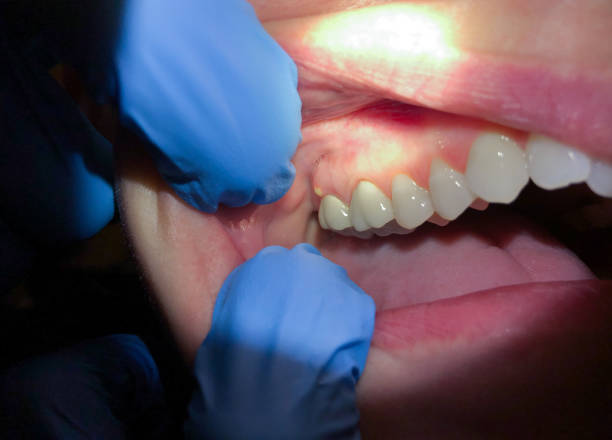 Best Emergency Tooth Extraction in Maize, KS